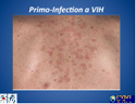 Diagnostic et Soins Primaires des Patients infectes au VIH