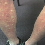dengue2