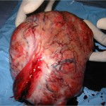 Fibroid tumors are commonly seen in a greatly advanced stage
