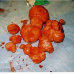 Fibroid tumors are commonly seen in a greatly advanced stage