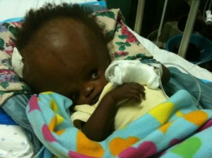 Baby with hydrocephalus–a heartbreaking occurrence seen way too often in Haiti. 