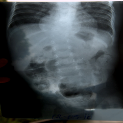Image from TB patient at Hôpital Sacré Coeur
