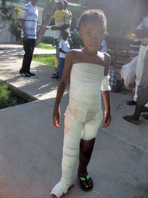 Girl with burns all over her body